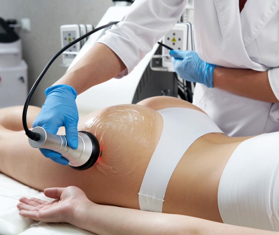 Levantamiento de Glúteos Sin Cirugía en Bogotá