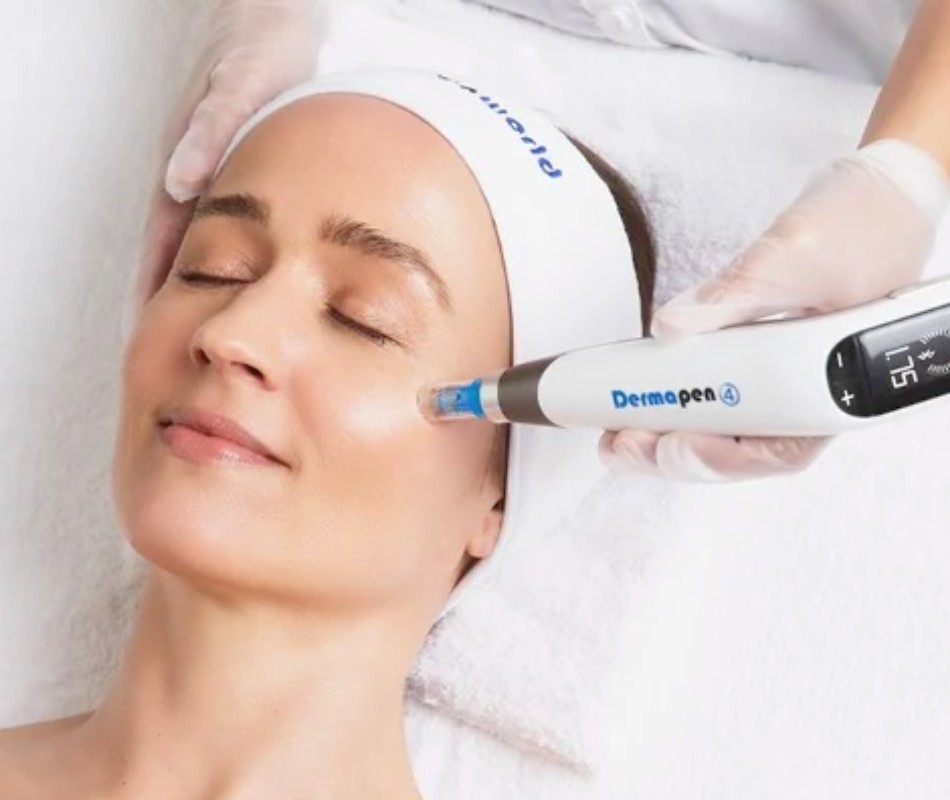 Tratamiento facial Dermapen (2)