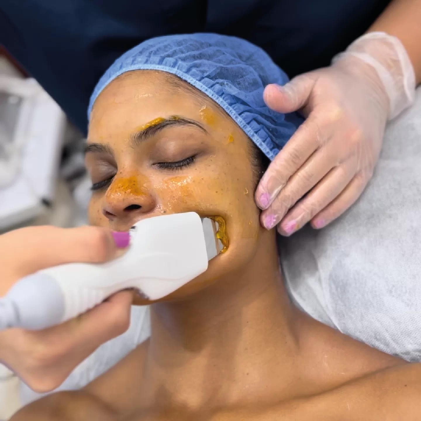 Hidrafacial y Limpieza Facial Profunda